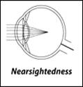 nearsightedness.gif (1957 bytes)